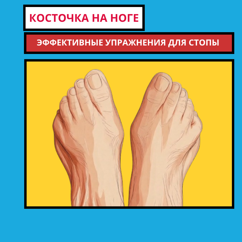 Программа «Косточка»: как остановить вальгусную деформацию большого пальца стопы